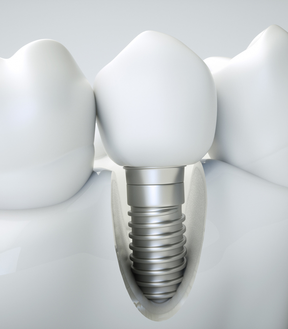 Dental Implant treatment with Dr Caroline Pase
