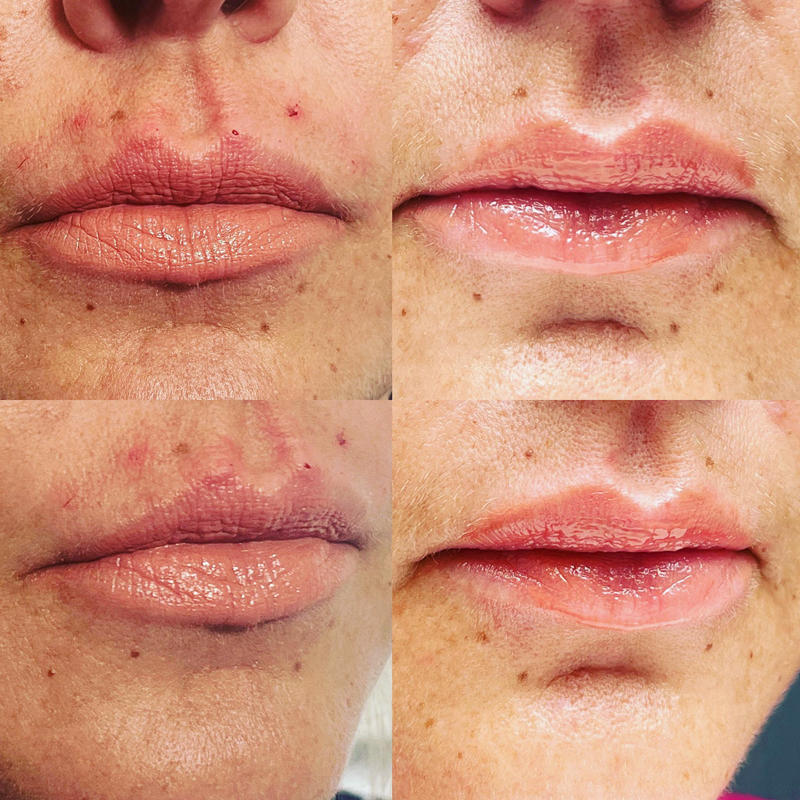 facial aesthetics before and after lip flip